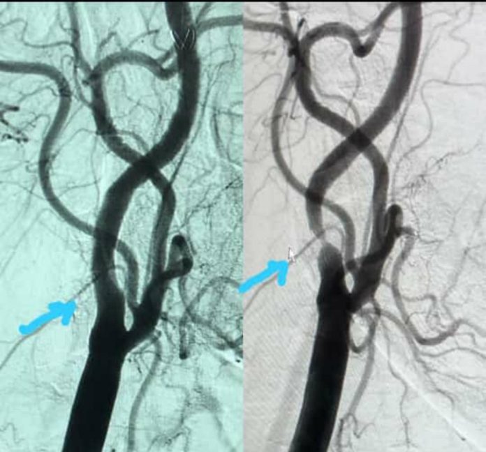 Interventional Cardiologist successfully performs a rare Carotid Stent Interventional Cardiologist successfully performs a rare Carotid Stent