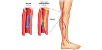 Peripheral Artery Disease Market Research Analysis Report 2021 to 2030