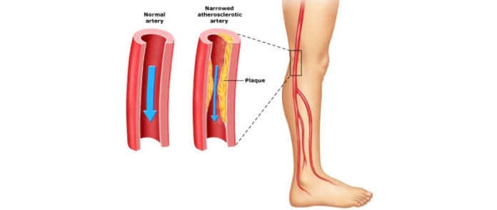 Peripheral Artery Disease Market Research Analysis Report 2021 to 2030 Peripheral Artery Disease Market Research Analysis Report 2021 to 2030