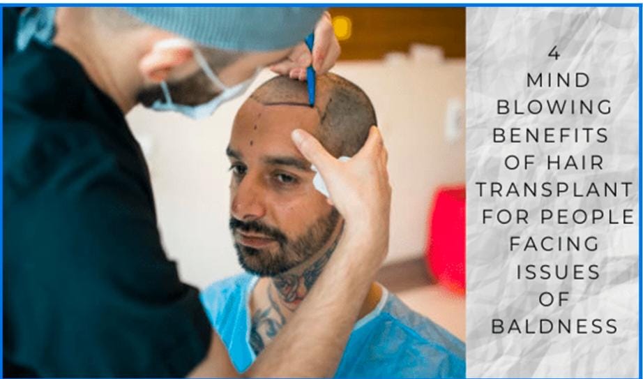 4 Mind Blowing Benefits of Hair Transplant for People Facing Issues of Baldness!