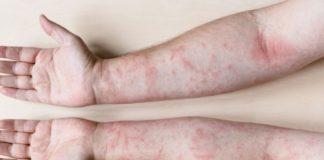 Early psoriasis intervention can save lives
