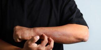 Eczema allergy skin, atopic dermatitis.