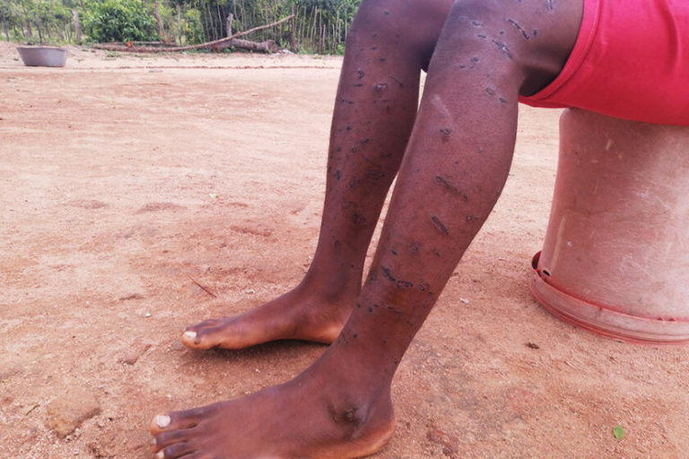Trevor Kusena's legs after he was bitten by dogs belonging to ZCDC security forces in Marange. Image courtesy of Farai Shawn Matiashe.jpg