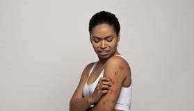 Psoriasis, a chronic skin condition