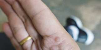 3 reasons children are more prone to warts… and how to treat them! 3 reasons children are more prone to warts… and how to treat them!