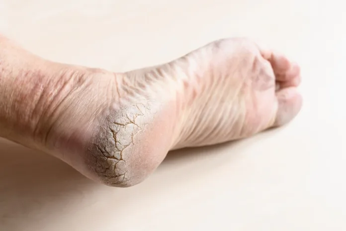 Picture1-1 Kroko shares 5 ageing footcare tips to keep feet healthy in later years