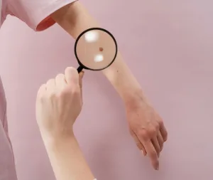 May is International Skin Cancer Awareness Month: Here’s how to recognise the signs of melanoma