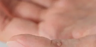 Myths vs Facts: What Causes Warts and How to Treat Them This Summer