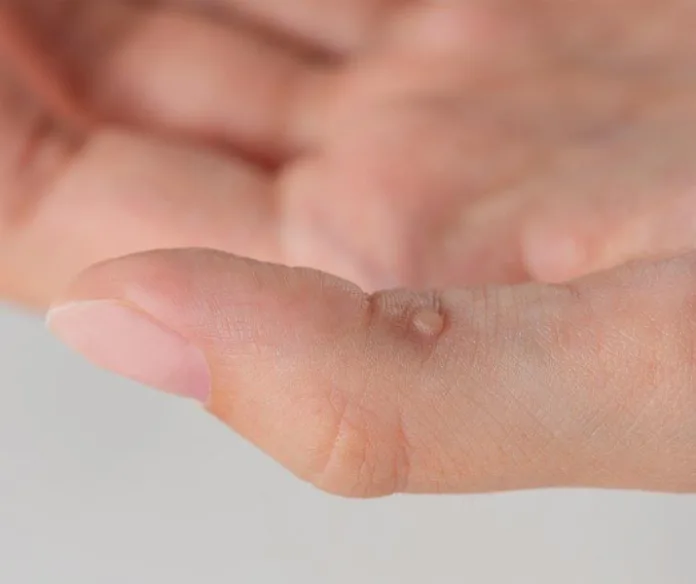 4 Myths vs Facts: What Causes Warts and How to Treat Them This Summer