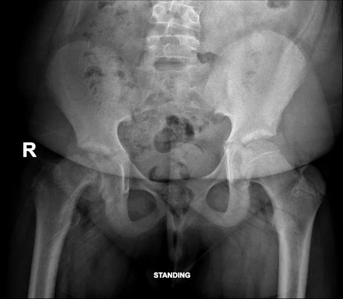 AP view of the hips