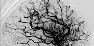 FAQs about strokes: Causes, warning signs and modern neuroimaging