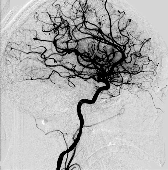 FAQs about strokes: Causes, warning signs and modern neuroimaging FAQs about strokes: Causes, warning signs and modern neuroimaging