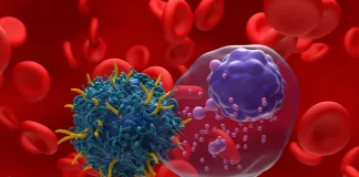 South Africa Shows a Higher Incidence of Multiple Myeloma Compared with Global Trends