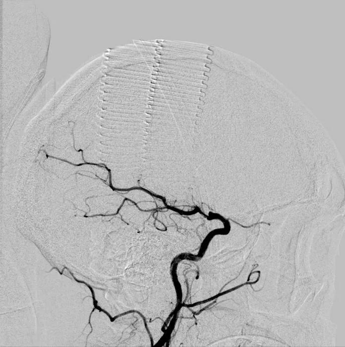 A Radiology imaging showing blockage to the arteries