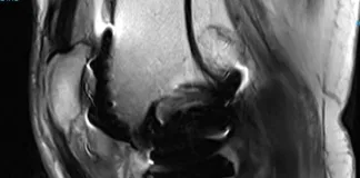 Is it safe to have an MRI after hip or knee replacement surgery?