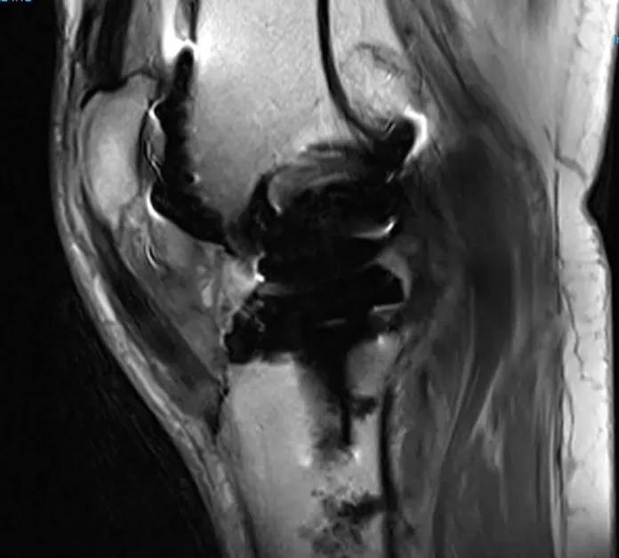 Is it safe to have an MRI after hip or knee replacement surgery?