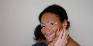 Living With Vitiligo: Myths And Confidence