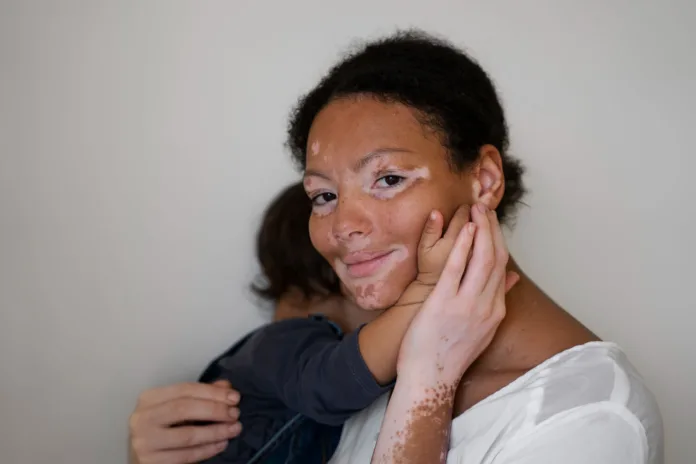Living-With-Vitiligo-Myths-And-Confidence Living With Vitiligo: Myths And Confidence