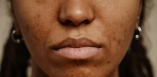 What Causes Petechiae? When Tiny Red Spots Could Be a Sign of Something Serious