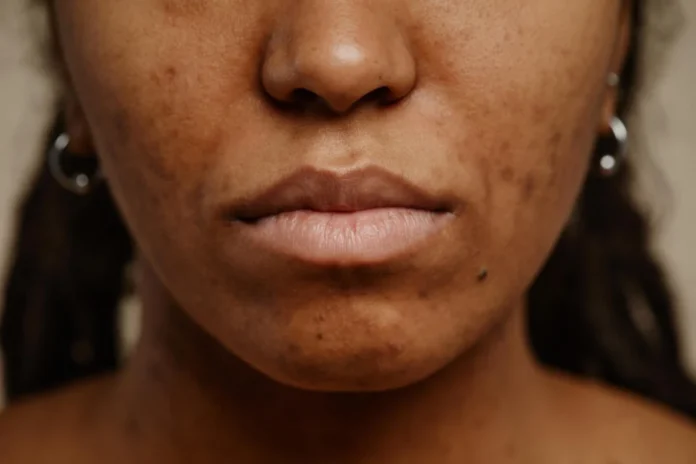 What Causes Petechiae? When Tiny Red Spots Could Be a Sign of Something Serious